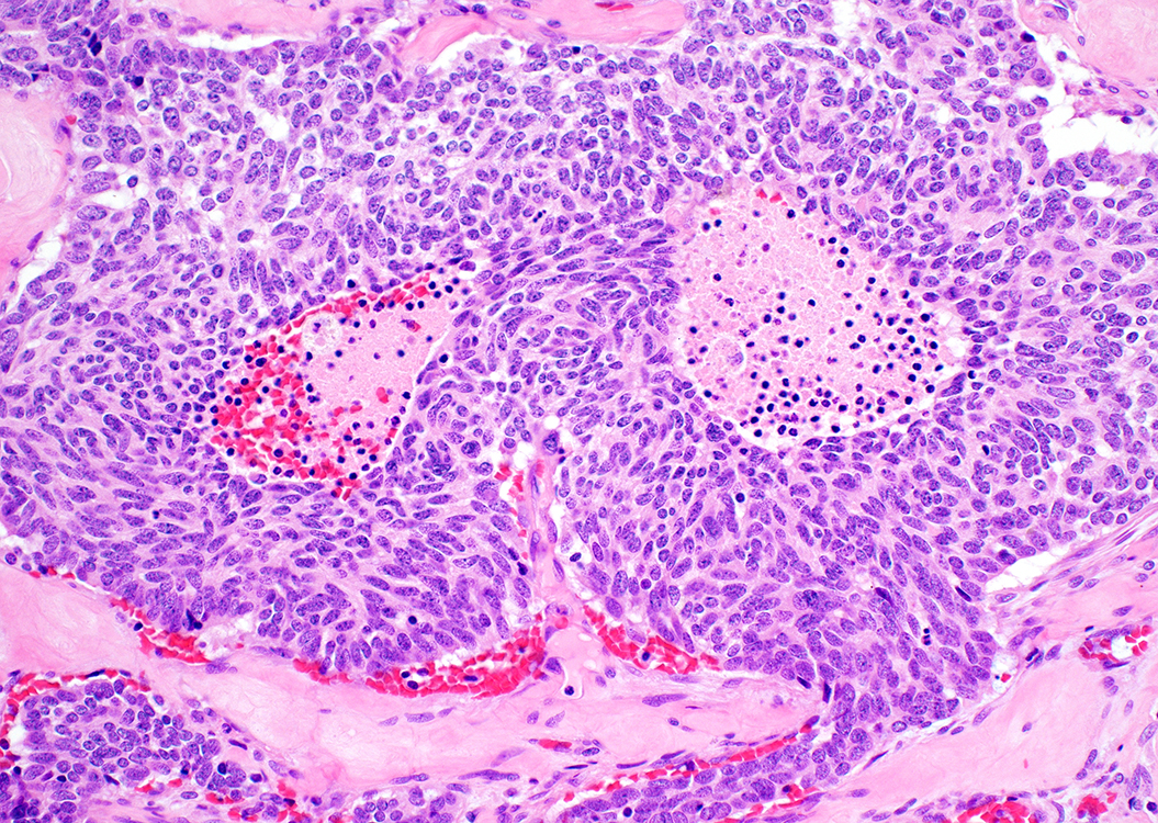 Fig 6 20X necrosis